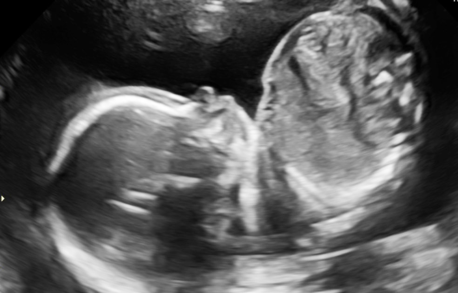 ivf-egg-transfer-success-20-week-fetal-baby-sonogram
